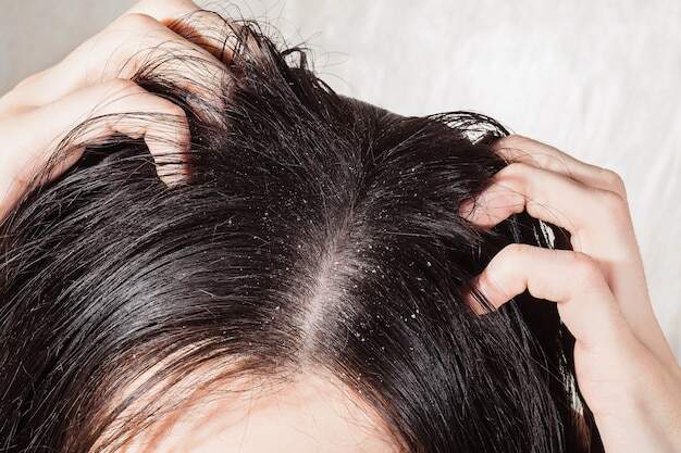 Dry And itchy Scalp